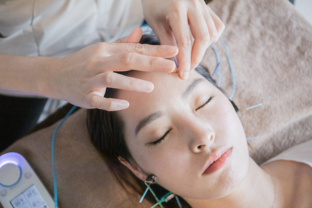 美容鍼でリフトアップやむくみにアプローチしている写真