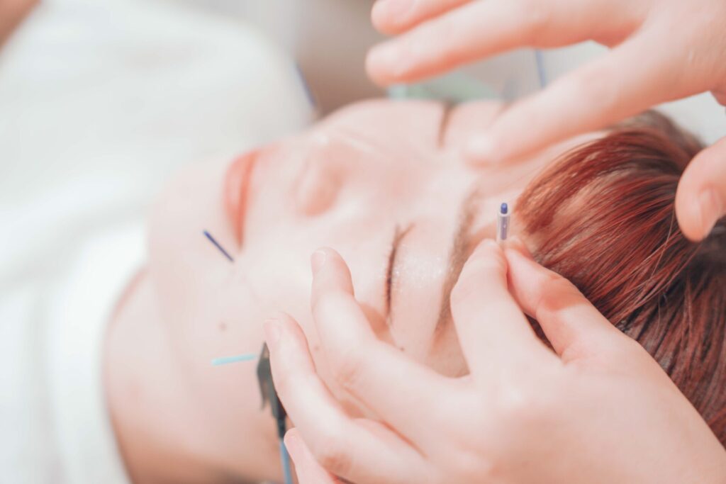 HariFa鍼灸院の美容鍼施術で目の周辺に鍼を打ち眼精疲労を改善する様子
